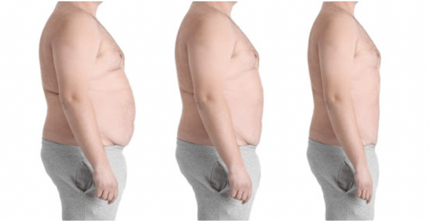 Palpitations Regurgitation Stopped Gait Corrected By Successfully Tackling Morbid Obesity